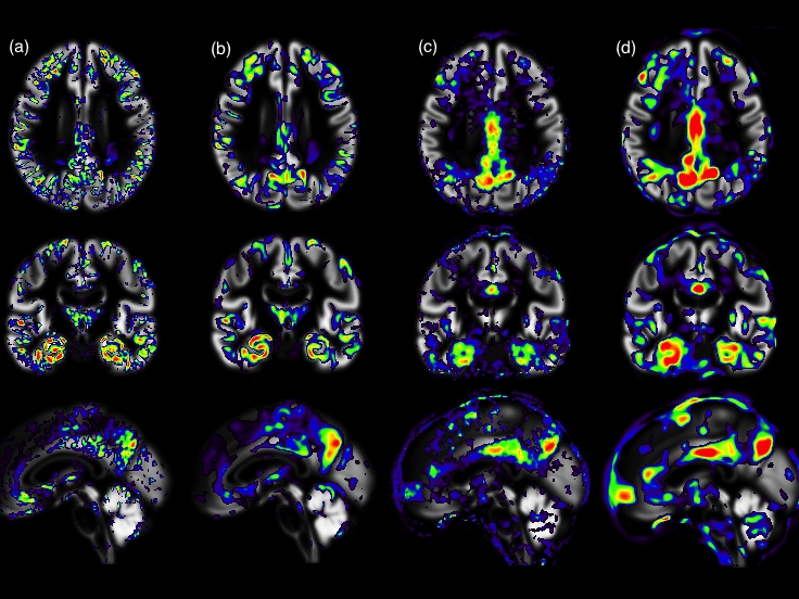 Yet another ADNI machine learning paper