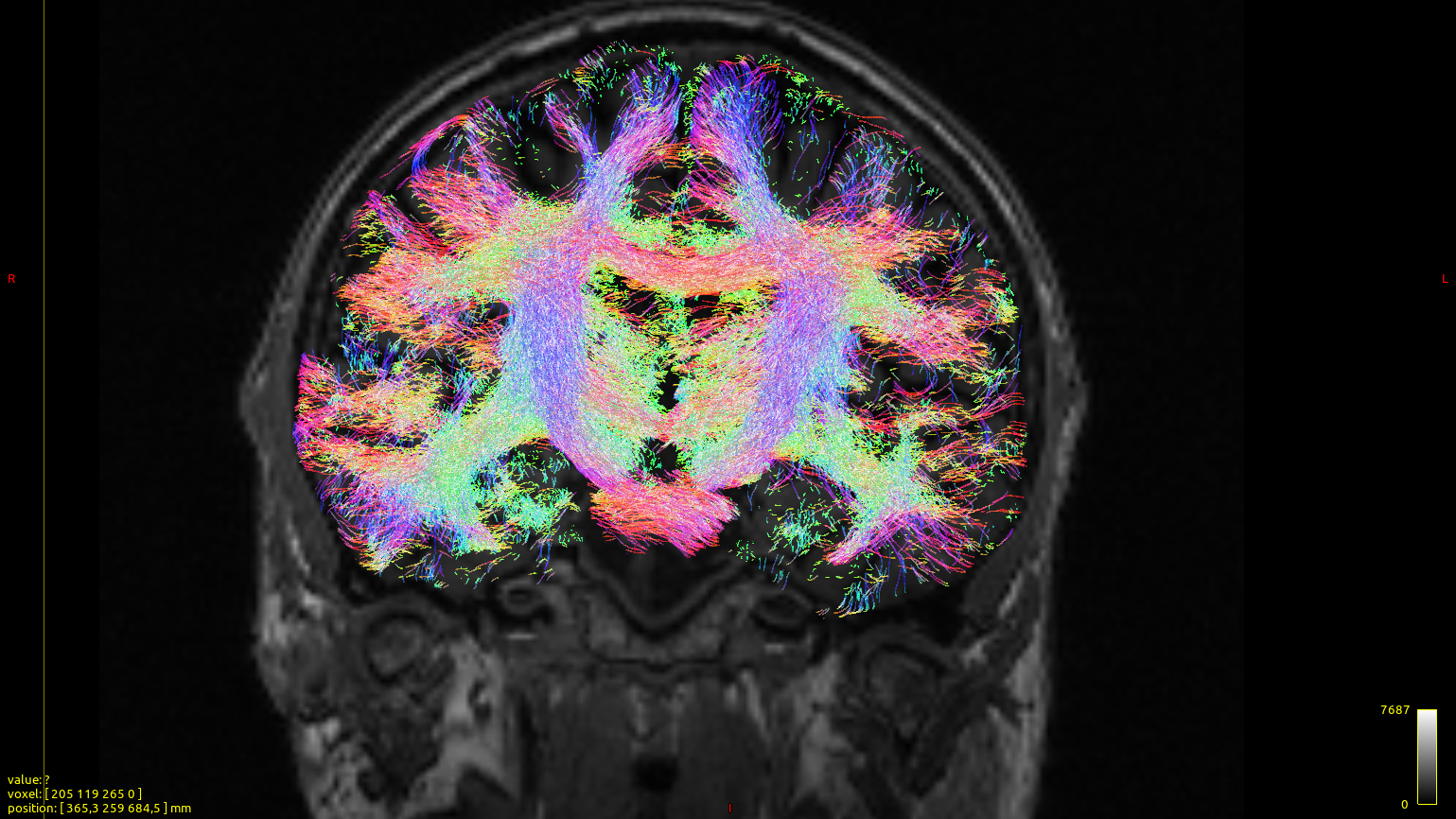 Tractographie montrant les connexions entre les différentes aires cérébrales