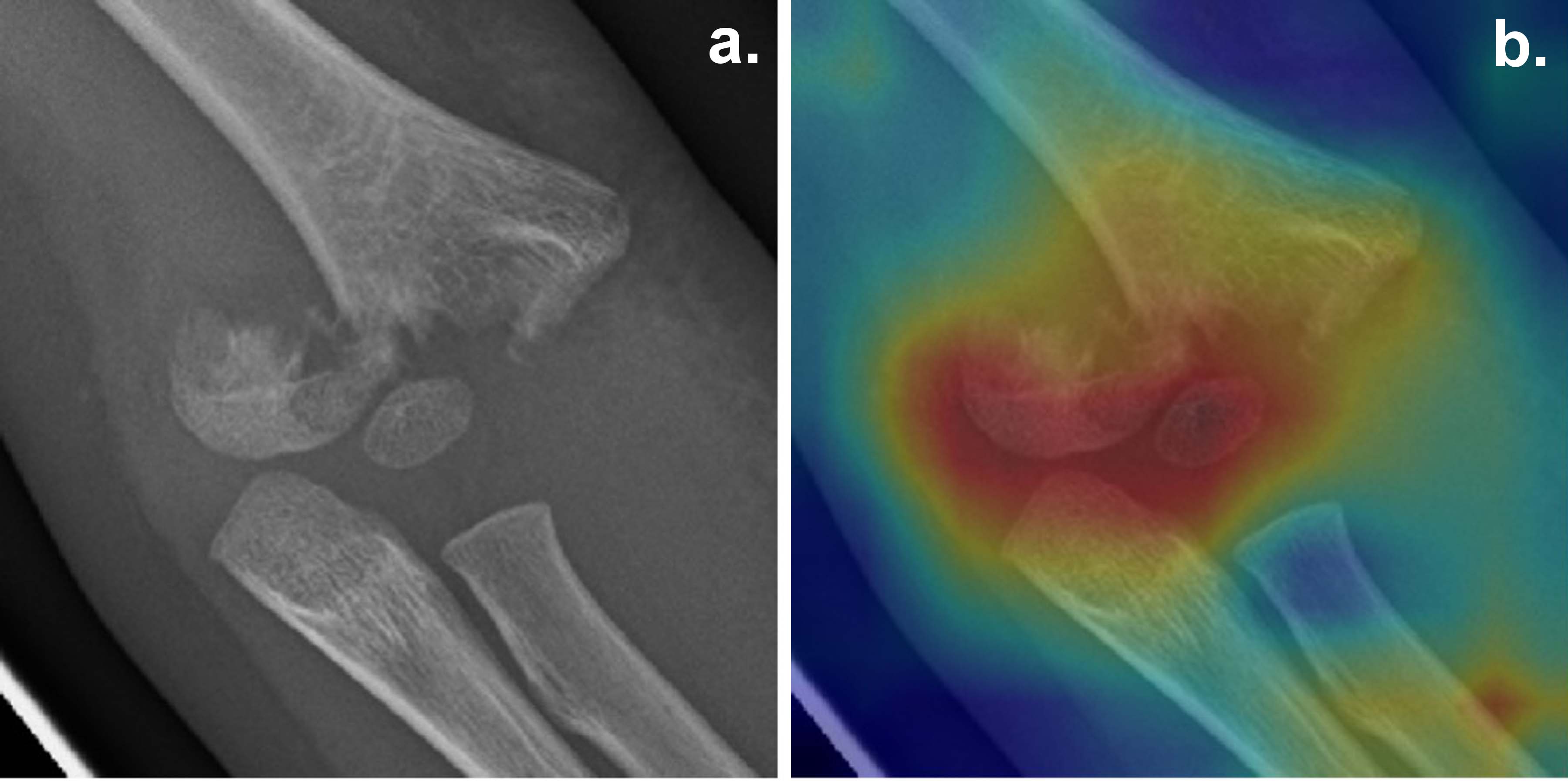 Radiologie du coude