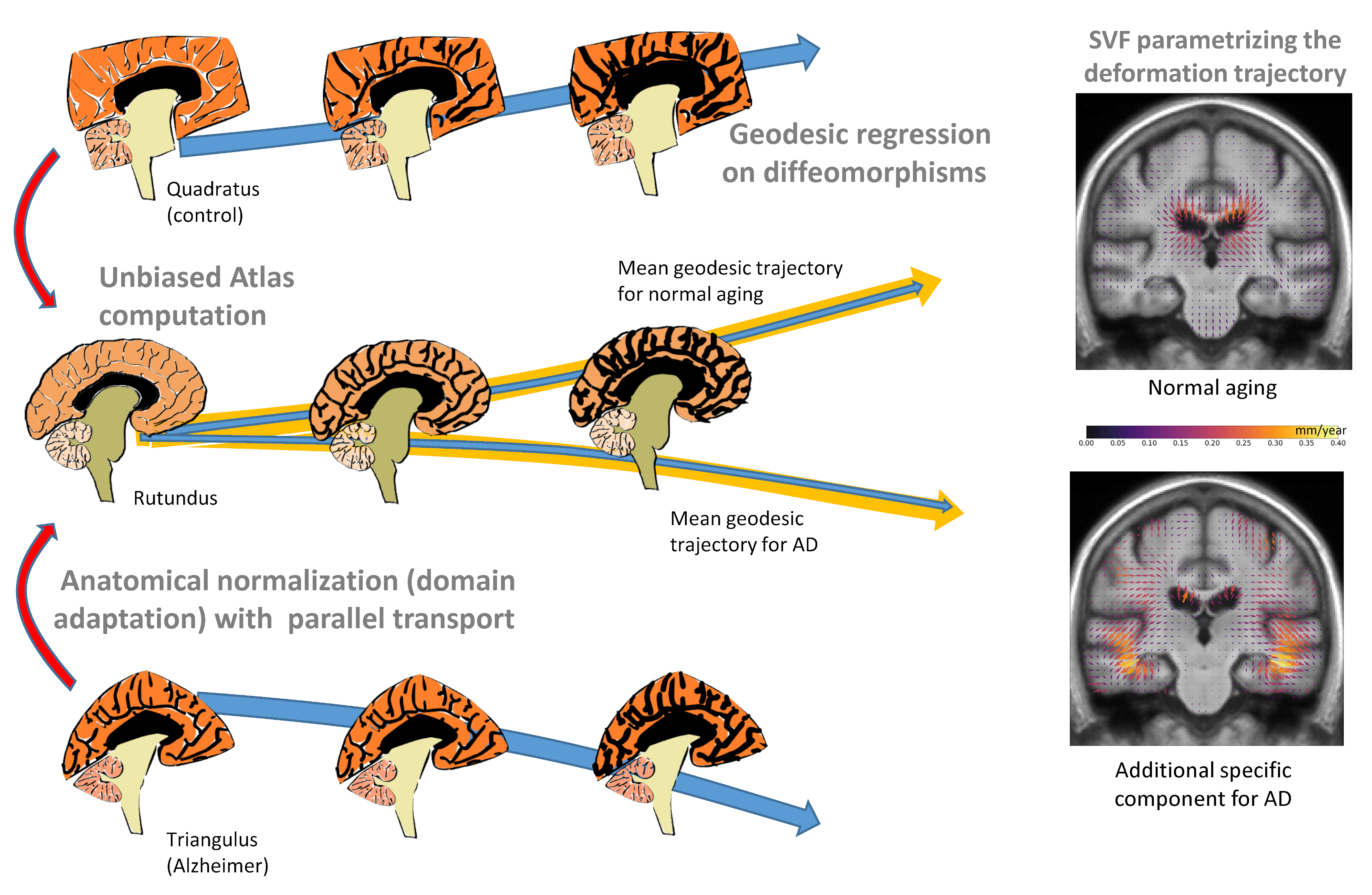 Statistics on diffeomorphisms with the Cartan-Schouten connection to model the evolution of the brain shape in Alzheimer’s disease