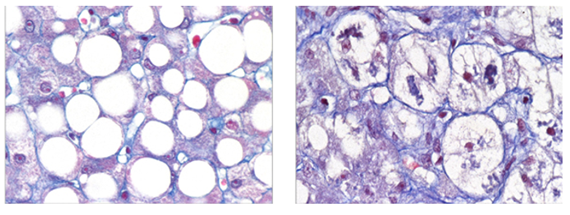 Représentation microscopique de la MASH. Crédits : François Pattou