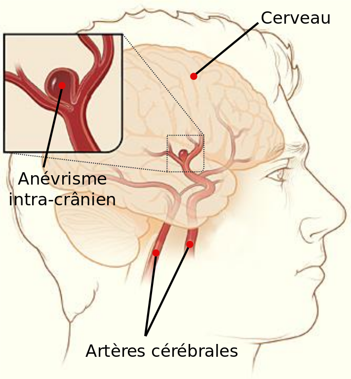 Schéma représentant un anévrisme intra-crânien.